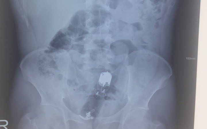 Nội soi đại tràng Sigma