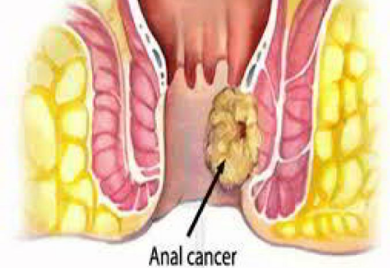 Nội soi đại tràng Sigma