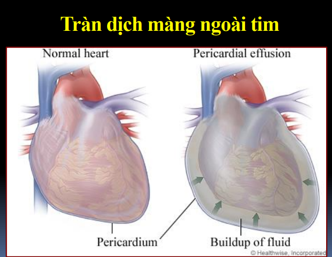 Ép tim cấp là gì? Các dấu hiệu nhận biết và điều trị
