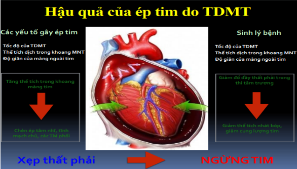 Ép tim cấp là gì? Các dấu hiệu nhận biết và điều trị