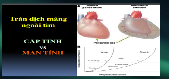 Ép tim cấp là gì? Các dấu hiệu nhận biết và điều trị