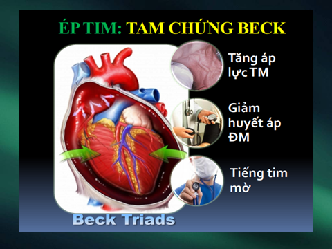 Ép tim cấp là gì? Các dấu hiệu nhận biết và điều trị
