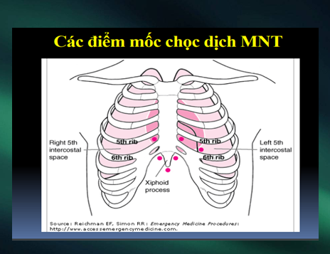 Ép tim cấp là gì? Các dấu hiệu nhận biết và điều trị