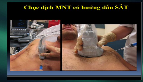 Ép tim cấp là gì? Các dấu hiệu nhận biết và điều trị