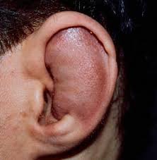 Viêm sụn vành tai điều trị thế nào?
