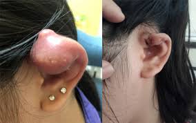 Nhận biết viêm màng sụn ở vành tai