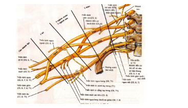 Tổn thương đám rối thần kinh cánh tay ở trẻ em
