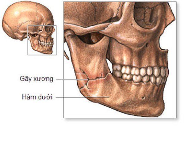 Điều trị gãy lồi cầu xương hàm dưới do chấn thương