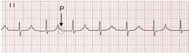 Block nhĩ thất độ 1 có nguy hiểm không?