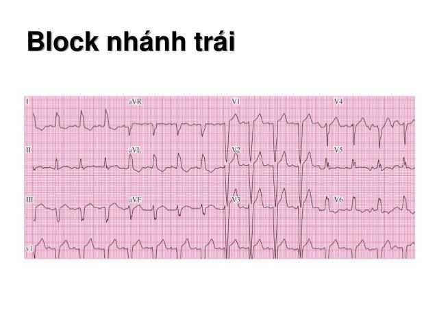 Tìm hiểu hiện tượng block nhánh trái ở tim