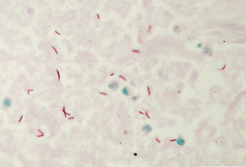 Xét nghiệm đờm AFB có ý nghĩa gì?