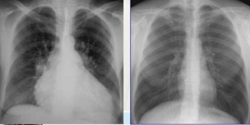 Các bất thường bóng tim trên X quang
