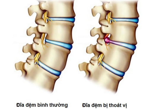 Những phương pháp chẩn đoán hình ảnh thoát vị đĩa đệm cột sống