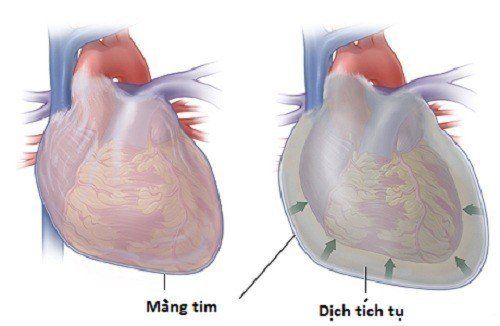 Phân biệt sốc tim, sốc giảm thể tích, sốc tắc nghẽn