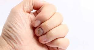 Sơ cứu dập móng tay đúng cách