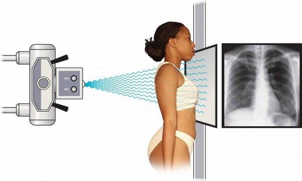 Đi chụp X - quang có phải cởi quần áo không