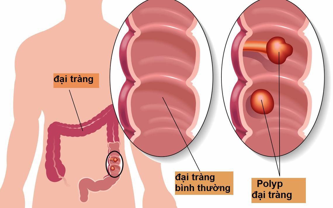 Đa polyp gia đình (FAP) là gì? Yếu tố nguy cơ