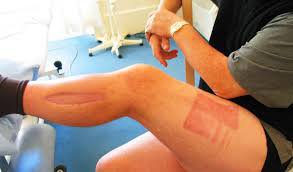 Chèn ép khoang sau liệu pháp tiêu sợi huyết điều trị thuyên tắc phổi