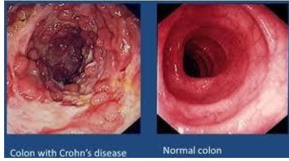 Thuốc chống tiêu chảy cho bệnh Crohn