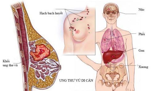 Liquid Biopsy - Sinh thiết lỏng trong chẩn đoán và tầm soát ung thư: những hứa hẹn và thách thức