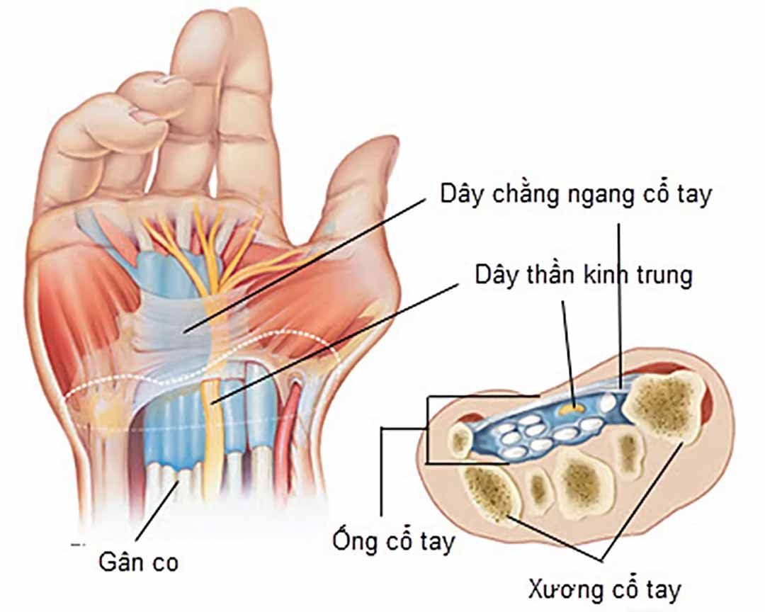 Siêu âm khớp cổ tay giúp chẩn đoán bệnh gì?