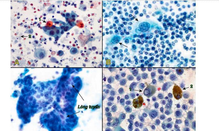 Tế bào học chọc hút bằng kim nhỏ (fna) - Các bệnh lý hạch lympho