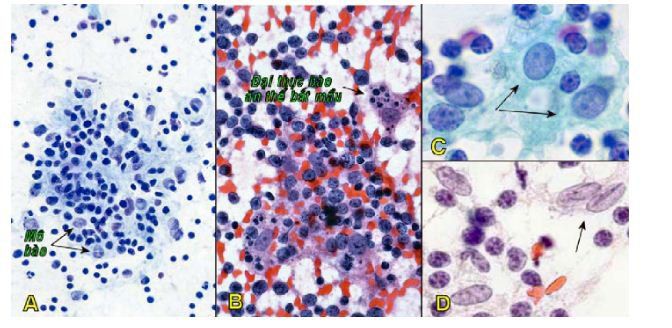 Tế bào học chọc hút bằng kim nhỏ (fna) - Các bệnh lý hạch lympho