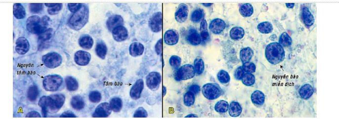 Tế bào học chọc hút bằng kim nhỏ (fna) - Các bệnh lý hạch lympho