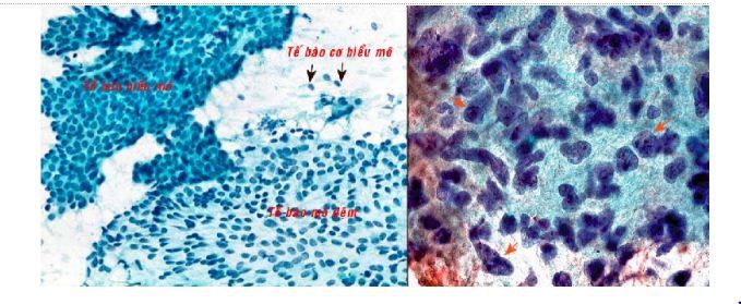 Tế bào học chọc hút bằng kim nhỏ (FNA) - Các tổn thương tuyến vú
