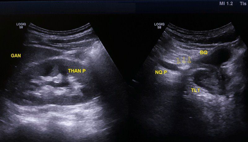 Chẩn đoán sỏi thận và sỏi bàng quang bằng siêu âm, X quang, CT scan