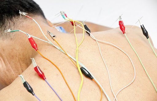 Điện châm điều trị hội chứng vai gáy