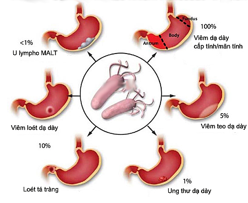 U malt dạ dày Phần 1: Tổng quan, chẩn đoán và triệu chứng