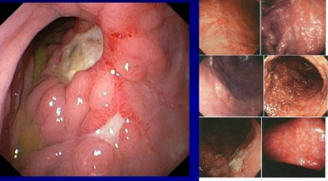 U malt dạ dày Phần 2: Giải phẫu, phân loại và cách điều trị