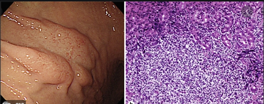 U malt dạ dày Phần 2: Giải phẫu, phân loại và cách điều trị