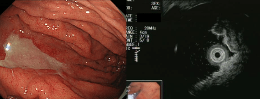 U malt dạ dày Phần 2: Giải phẫu, phân loại và cách điều trị