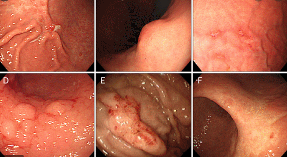 U malt dạ dày Phần 2: Giải phẫu, phân loại và cách điều trị