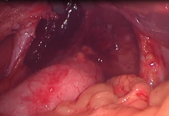 Điều trị thoát vị khe hoành phần 1: Điều trị bằng nội khoa và phẫu thuật