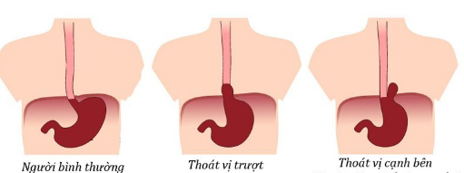 Điều trị thoát vị khe hoành phần 1: Điều trị bằng nội khoa và phẫu thuật