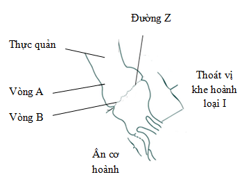 Cơ hoành và thoát vị khe hoành