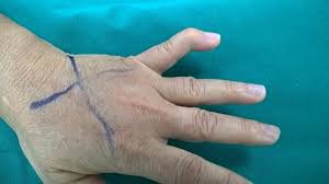 Ngón tay rơi - Ngón tay Mallet: Nguyên nhân, chẩn đoán và điều trị