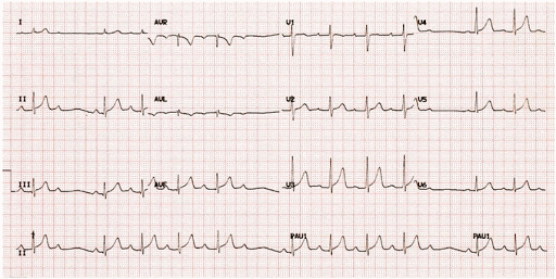 Chẩn đoán và điều trị block nhĩ thất
