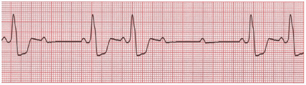 Chẩn đoán và điều trị block nhĩ thất
