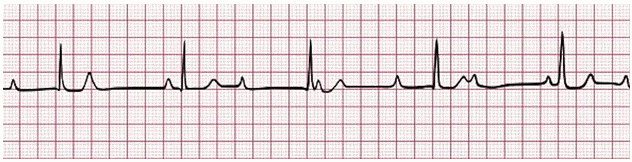 Chẩn đoán và điều trị block nhĩ thất