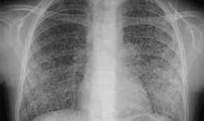 Những tổn thương cơ bản ở bệnh phổi phát hiện trên X quang