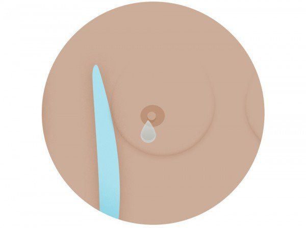 U nang tuyến vú đơn thuần: Những điều cần biết