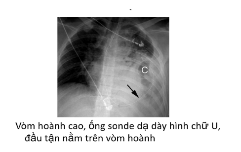 Chấn thương ngực gây vỡ cơ hoành
