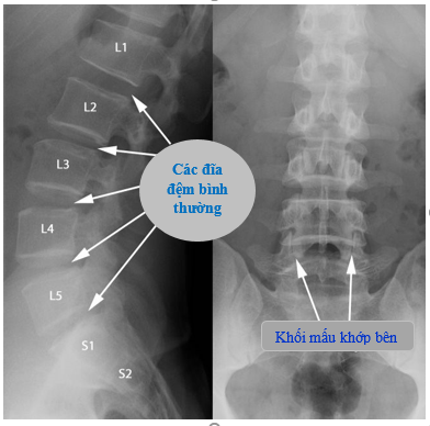 Giải phẫu X - quang cột sống: Với hình ảnh X quang giải phẫu cột sống, bạn có thể tìm hiểu sâu hơn về cấu trúc và chức năng của cột sống. Điều này sẽ giúp bạn có được kiến thức toàn diện về cột sống, từ đó có cách phòng ngừa và điều trị tốt hơn.
