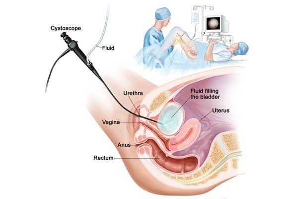Cách lấy bệnh phẩm nước tiểu và 3 phương pháp lấy mẫu nước tiểu cấy