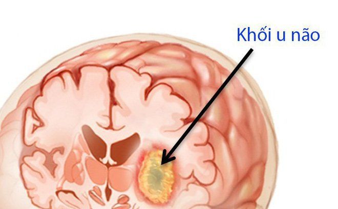 Hình ảnh cắt lớp vi tính chấn thương sọ não