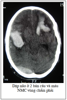 Hình ảnh cắt lớp vi tính chấn thương sọ não